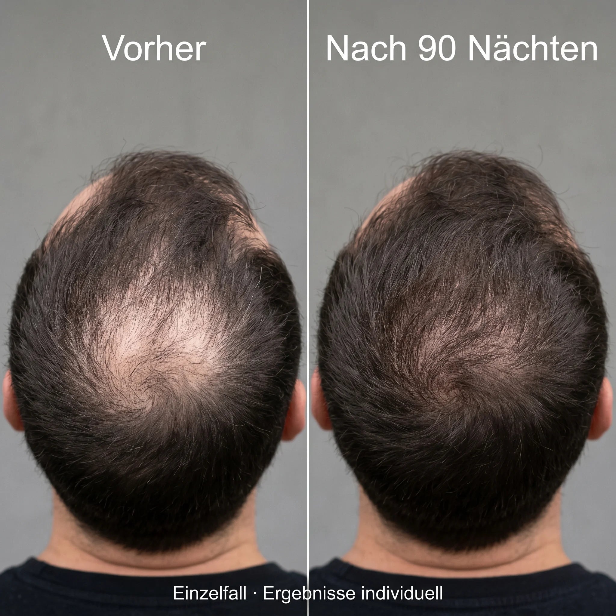 Vorher-Nachher Tonsur, von oben fotografiert. Einzelfall, Ergebnisse individuell.