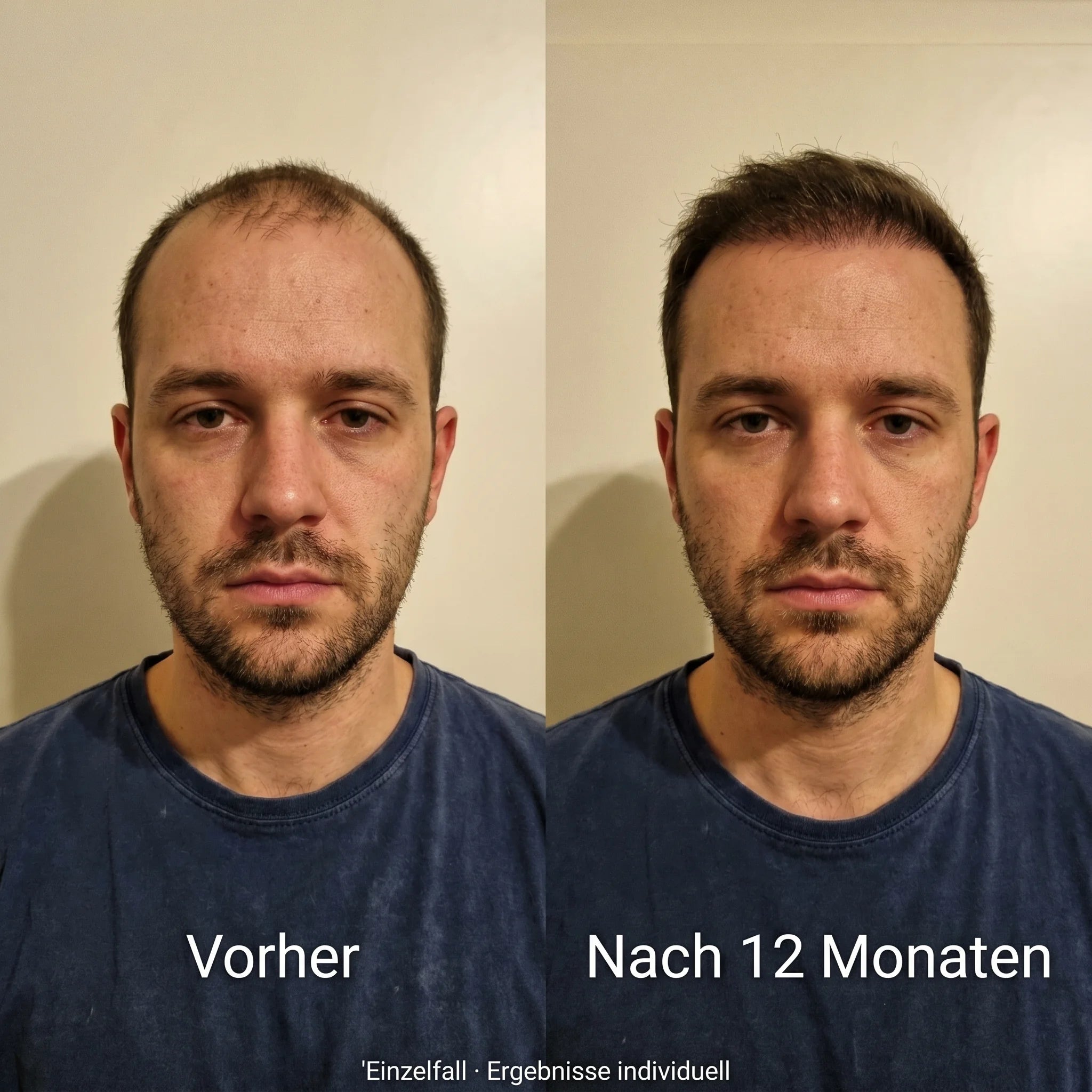 Vorher-Nachher Haaransatz, frontal. Einzelfall, Ergebnisse individuell.