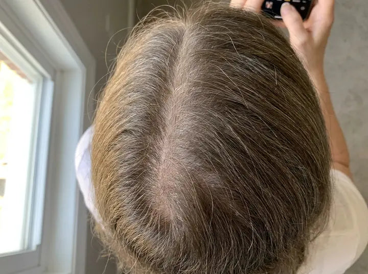 Der Scheitel wird breiter, weil DHT die Haarwurzeln dort besonders angreift. Aber die Forschung zeigt: Das lässt sich beeinflussen.